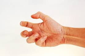 Ulnar Nerve Entrapment